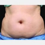 CoolSculpting Before & After Patient #2133