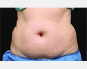 CoolSculpting Before & After Patient #2133