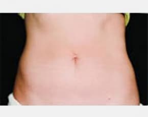 CoolSculpting Before & After Patient #2132