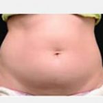 CoolSculpting Before & After Patient #2132