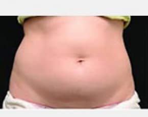 CoolSculpting Before & After Patient #2132