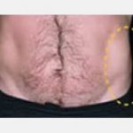 CoolSculpting Before & After Patient #2116
