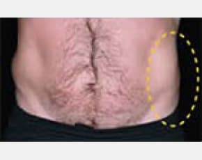 CoolSculpting Before & After Patient #2116