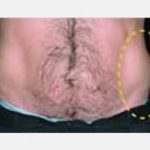 CoolSculpting Before & After Patient #2116