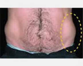 CoolSculpting Before & After Patient #2116