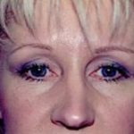 Eyelid Surgery Browlift Before & After Patient #1844