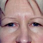 Eyelid Surgery Browlift Before & After Patient #1844