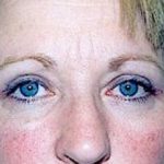 Eyelid Surgery Browlift Before & After Patient #1843