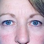 Eyelid Surgery Browlift Before & After Patient #1843