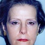 Eyelid Surgery Browlift Before & After Patient #1842