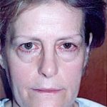 Eyelid Surgery Browlift Before & After Patient #1842