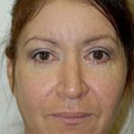 Eyelid Surgery Browlift Before & After Patient #1841