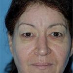 Eyelid Surgery Browlift Before & After Patient #1841