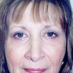 Eyelid Surgery Browlift Before & After Patient #1840