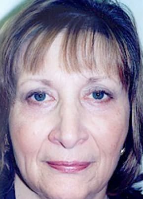 Eyelid Surgery Browlift Before & After Patient #1840