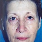Eyelid Surgery Browlift Before & After Patient #1840