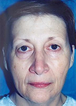 Eyelid Surgery Browlift Before & After Patient #1840