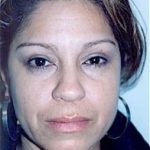 Eyelid Surgery Browlift Before & After Patient #1839