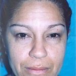 Eyelid Surgery Browlift Before & After Patient #1839