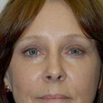Eyelid Surgery Browlift Before & After Patient #1838
