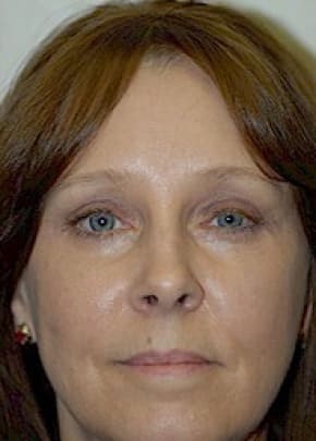 Eyelid Surgery Browlift Before & After Patient #1838