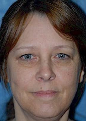 Eyelid Surgery Browlift Before & After Patient #1838
