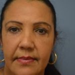 Eyelid Surgery Browlift Before & After Patient #1837
