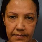 Eyelid Surgery Browlift Before & After Patient #1837