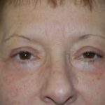Eyelid Surgery Browlift Before & After Patient #1836