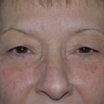 Eyelid Surgery Browlift Before & After Patient #1836