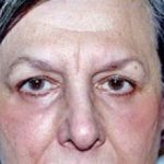 Eyelid Surgery Browlift Before & After Patient #1835