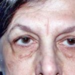 Eyelid Surgery Browlift Before & After Patient #1835