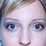 Eyelid Surgery Browlift Before & After Patient #1834