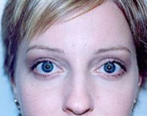 Eyelid Surgery Browlift Before & After Patient #1834