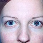 Eyelid Surgery Browlift Before & After Patient #1834