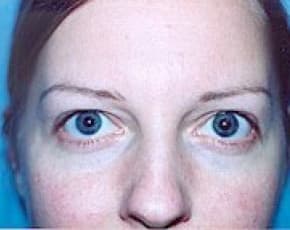 Eyelid Surgery Browlift Before & After Patient #1834