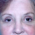 Eyelid Surgery Browlift Before & After Patient #1833