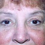Eyelid Surgery Browlift Before & After Patient #1833
