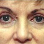 Eyelid Surgery Browlift Before & After Patient #1832