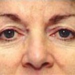 Eyelid Surgery Browlift Before & After Patient #1832