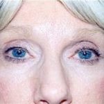 Eyelid Surgery Browlift Before & After Patient #1831