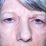 Eyelid Surgery Browlift Before & After Patient #1831