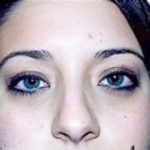 Eyelid Surgery Browlift Before & After Patient #1830
