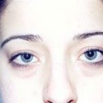 Eyelid Surgery Browlift Before & After Patient #1830