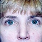 Eyelid Surgery Browlift Before & After Patient #1829