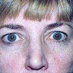 Eyelid Surgery Browlift Before & After Patient #1829