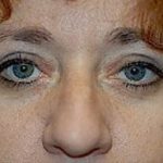 Eyelid Surgery Browlift Before & After Patient #1828