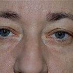 Eyelid Surgery Browlift Before & After Patient #1828