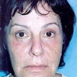 Eyelid Surgery Browlift Before & After Patient #1827