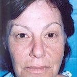 Eyelid Surgery Browlift Before & After Patient #1827